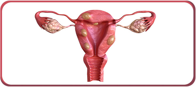 What Happens If Fibroids Go Untreated Near Me in Arcadia, CA, and Glendale, CA?