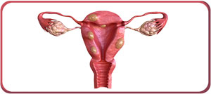 What Happens If Fibroids Go Untreated Near Me in Arcadia, CA, and Glendale, CA?